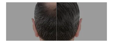 Business 3 image EUDERMIZ SKIN, HAIR & LASER CENTER - NALLAGANDLA, HYDERABAD Dermatologist in Hyderabad TG